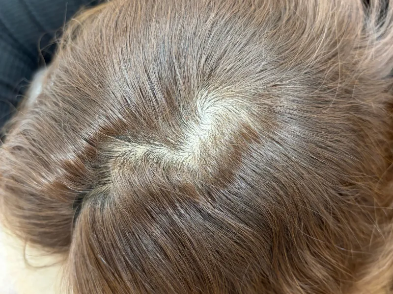 施術前：女性・分け目の透け