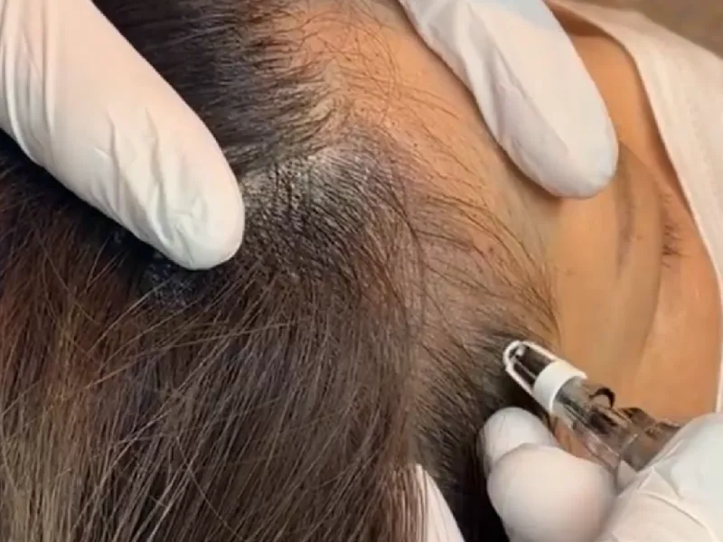 薄毛対策（SMP）の様子