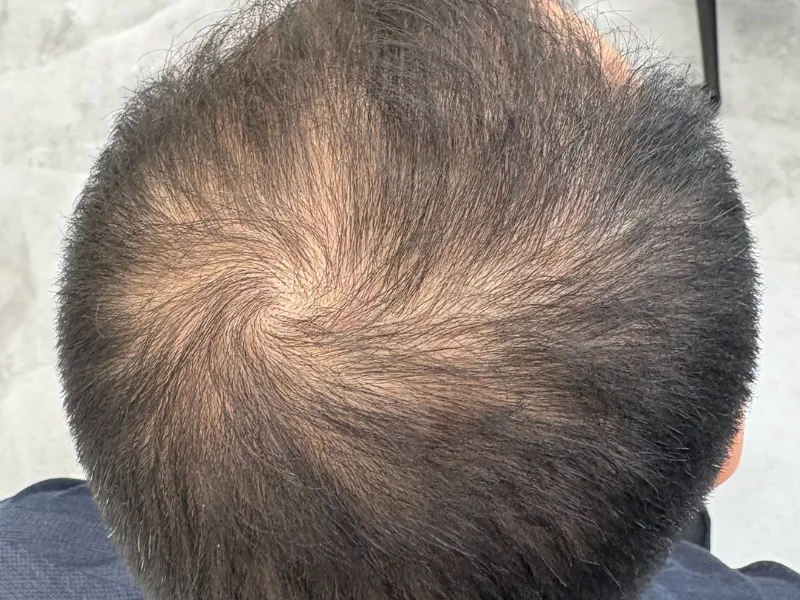 施術前：男性・頭頂部薄毛
