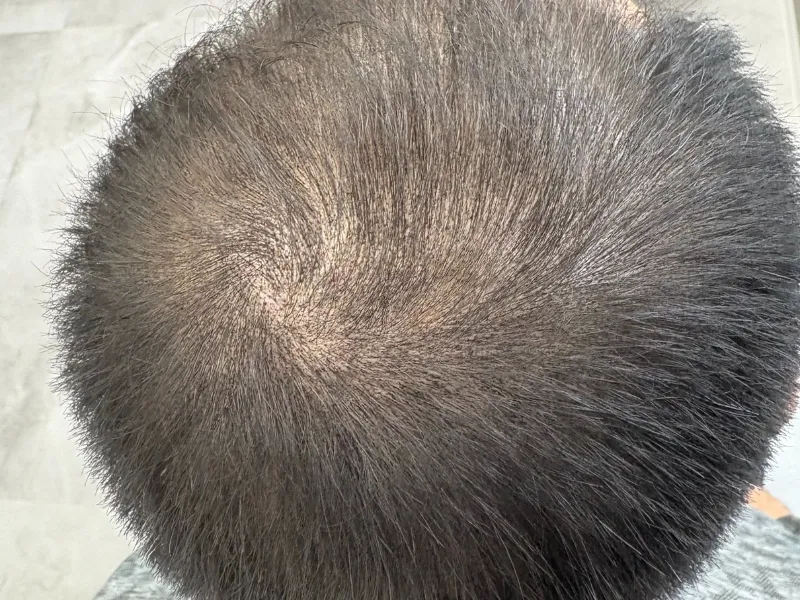 施術後：男性・頭頂部薄毛カバー